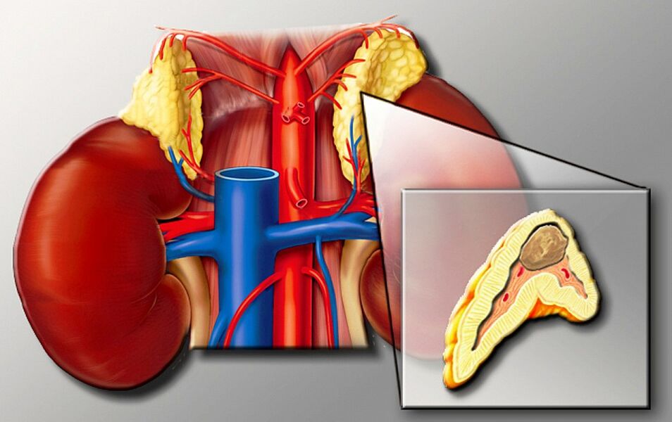 Feochromocytoma για υπέρταση